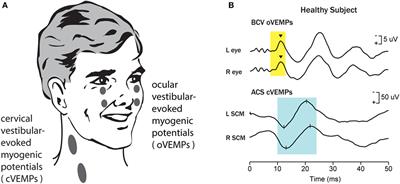 Otolithic Receptor Mechanisms for Vestibular-Evoked Myogenic Potentials: A Review